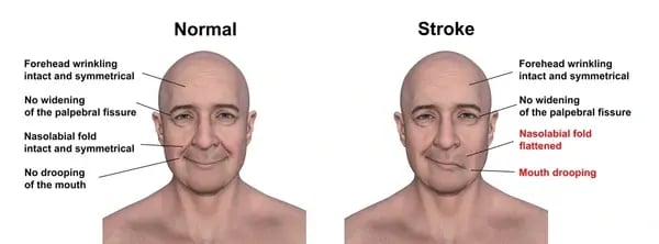 man-showing-leftside-stroke-drooping-600nw-2531258143